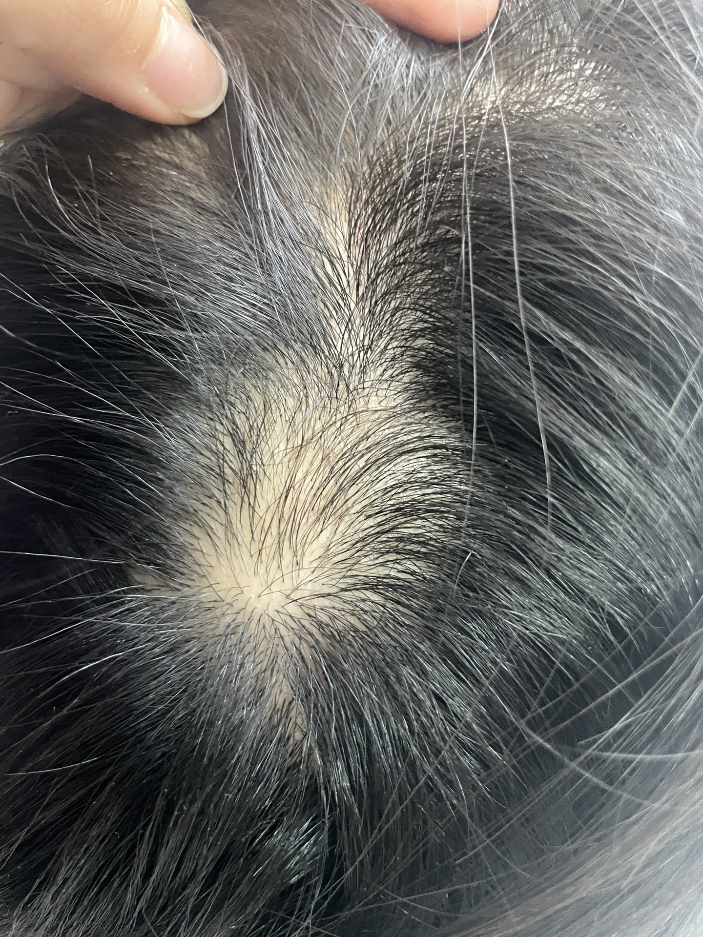 斑秃研究最新进展揭秘