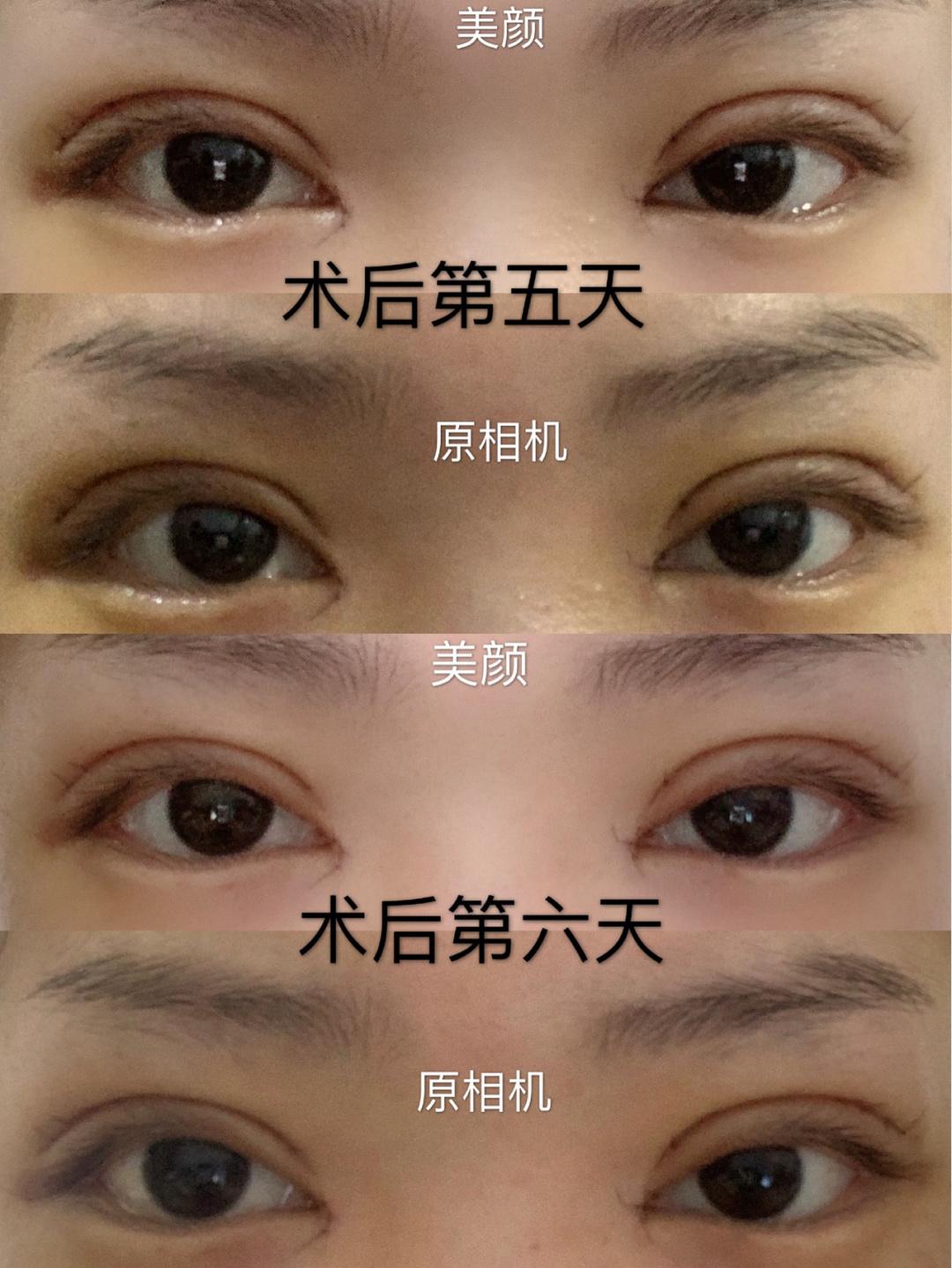 全面解析双眼皮手术价格及费用明细
