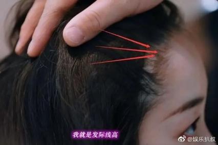 星光熠熠的人生转变之旅，明星们的植发之旅与自信闪耀之路